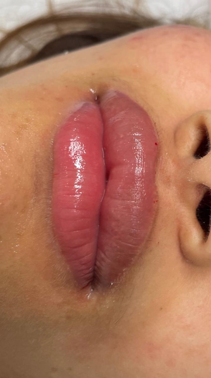 After - Under Eye Hollowness Filling